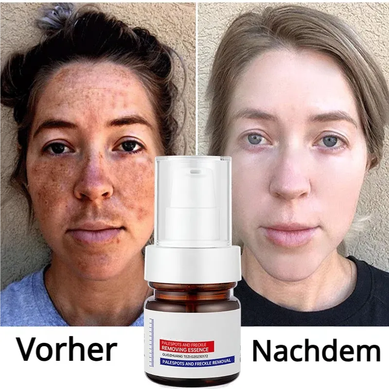 5-Sekunden-Aufhellung! Vitamin C-Aufhellungsessenz gegen Pigmentflecken